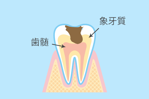 深い虫歯治療、歯冠修復