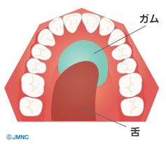 ワイヤー矯正で滑舌が悪くなることはある?