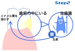 むし歯とは・・・?