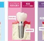 インプラントの寿命と気をつけたい病気とは