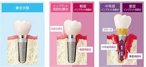 インプラント周囲炎を予防するためのセルフケア