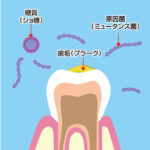 インプラントの寿命と気をつけたい病気とは