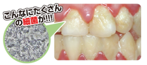プラークが歯石になるまで