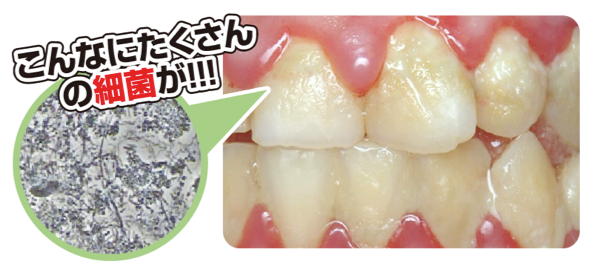 細菌のかたまり「プラーク」について
