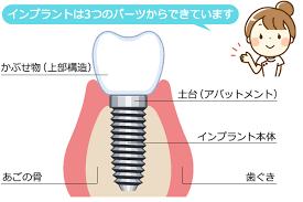 インプラントはどのような構造をしているの？