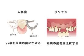 インプラントの特長ってなに?