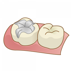 歯の詰め物と被せ物の違い