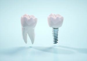 インプラントに使用される素材の安全性