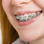 ワイヤー矯正中に気になる口内炎と、その対処法