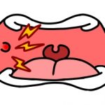 ワイヤー矯正中に気になる口内炎と、その対処法