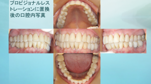 インプラント症例ブログ　その３