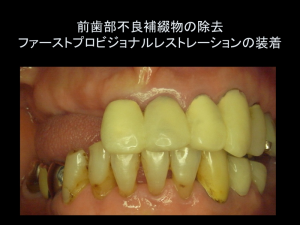 インプラント症例ブログ その4