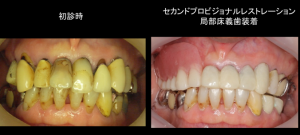 インプラント症例ブログ その4
