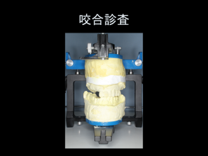 インプラント症例ブログ その4