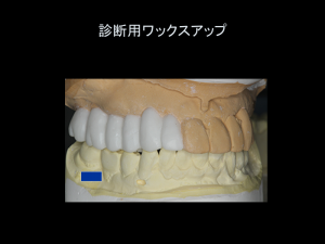 インプラント症例ブログ その4