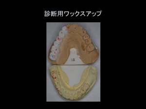 インプラント症例ブログ その4