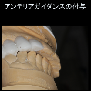 インプラント症例ブログ その4