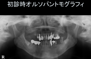 インプラント症例ブログ その4
