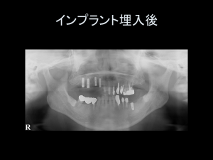 インプラント症例ブログ その4