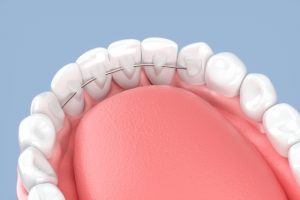 治療が終わっても気は抜けない？ワイヤー矯正後の保定期間の重要性