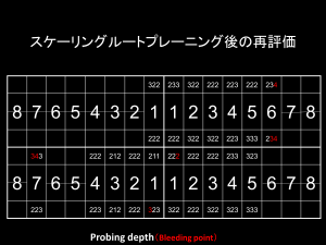 インプラント症例ブログ その4