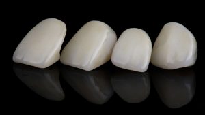 セラミックは一生もの？長持ちさせる方法も解説