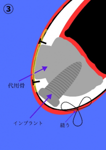インプラント治療症例ブログ6 (前編)