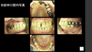 インプラント治療症例ブログ6 (前編)
