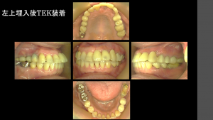 インプラント治療症例ブログ (後編)