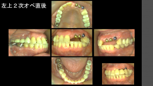 インプラント治療症例ブログ (後編)