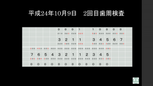 インプラント治療症例ブログ6 (前編)