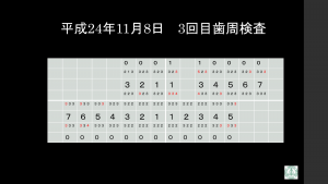 インプラント治療症例ブログ6 (前編)