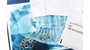 歯列矯正の顎間ゴムとは？その効果や使い方、注意点を解説
