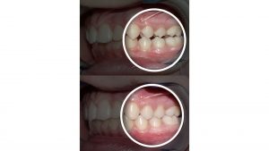 歯列矯正の顎間ゴムとは？その効果や使い方、注意点を解説