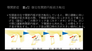 症例ブログ:顎関節症とその治療について