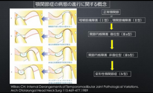 症例ブログ:顎関節症とその治療について その2