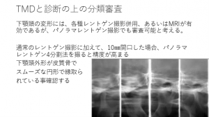 症例ブログ:顎関節症とその治療について その2